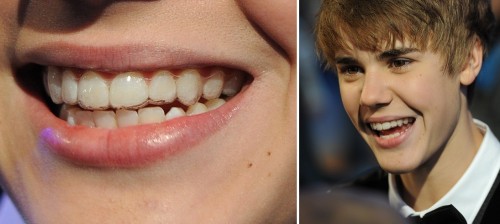 Justin Bieber - Justin Bieber hat eine Zahnspange Justin Bieber - Justin Bieber hat eine Zahnspange