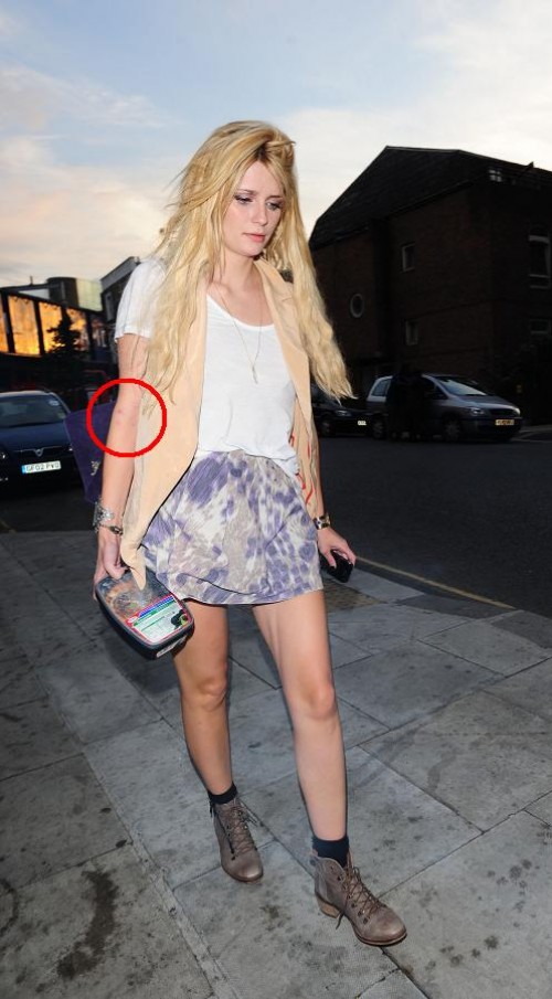 Mischa Barton, Amy Winehouse - Mischa Barton mit roten Pusteln, die könnten auf Leberschäden hinweisen