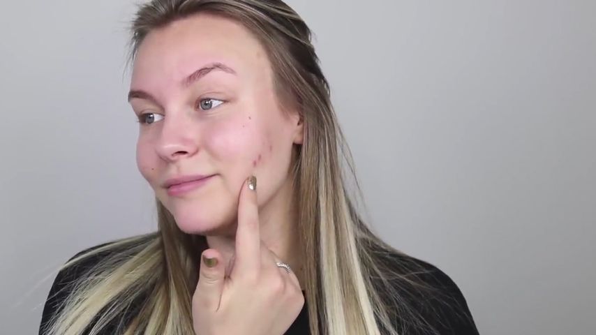 Dagi Bee offen: Sie hat Haut-Rötung nach Absetzen der Pille