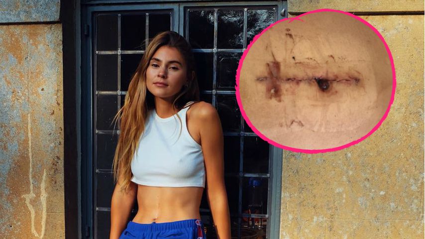 Nach Bauch-OP: Stefanie Giesinger zeigt ihre Narben-Chronik!